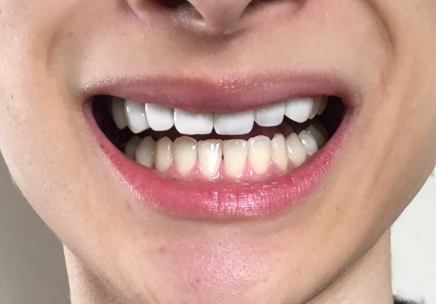 20日間で歯を白くする！自宅で確実にホワイトニング出来ると口コミのコルゲートの歯磨き粉 オプティックホワイト ハイインパクトを使ってみた結果！