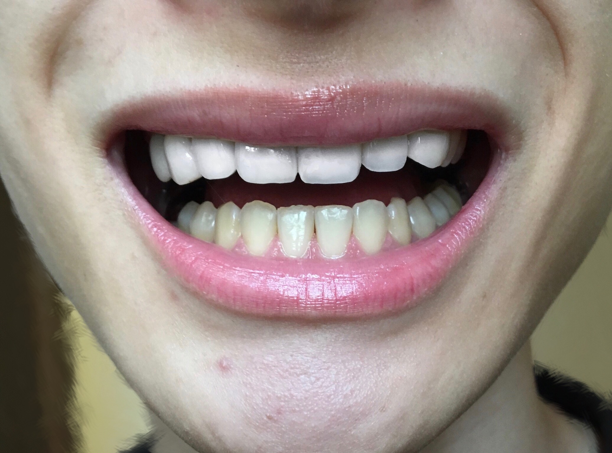 20日間で歯を白くする！自宅で確実にホワイトニング出来ると口コミのコルゲートの歯磨き粉 オプティックホワイト ハイインパクトを使ってみた結果！